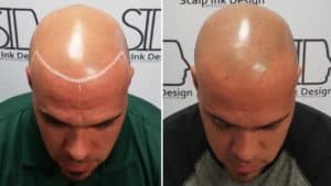 Scalp Micropigmentation is completely safe and a sure way to restore hair loss
