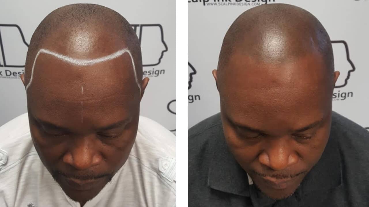 Scalp Micropigmentation in Miami Before and After Photos
