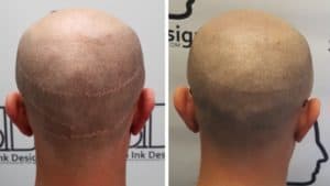 Darrian - Hair Transplant Scars Hidden with Scalp Micropigmentation by Scalp Ink Design