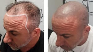 Scalp Micropigmentation for Men by Scalp Ink Design - SMP helps to hide hair loss