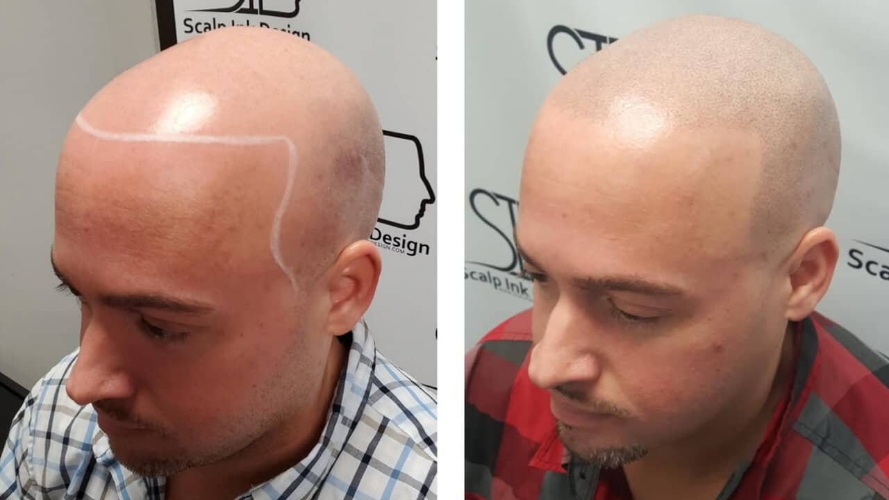 Hair Tattoo Before and After - Scalp Ink Design - Miami Margate West Palm Beach Port St Lucie - Hair Loss Treatment