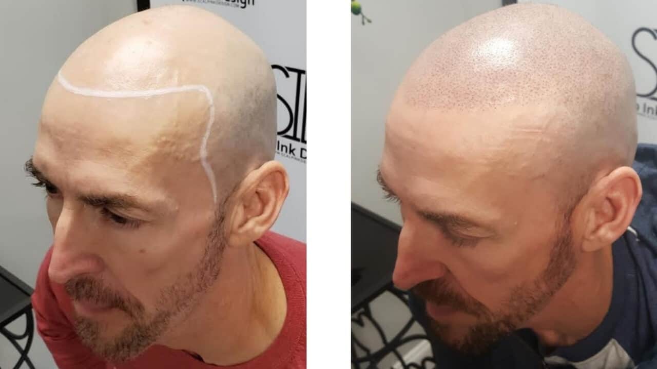 Hair Tattoo Before and After - Scalp Ink Design - Miami Margate West Palm Beach Port St Lucie