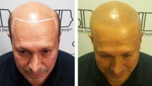 Scalp Micropigmentation Before and After - Scalp Ink Design - Miami Margate West Palm Beach Port St Lucie - Hair Loss Treatment