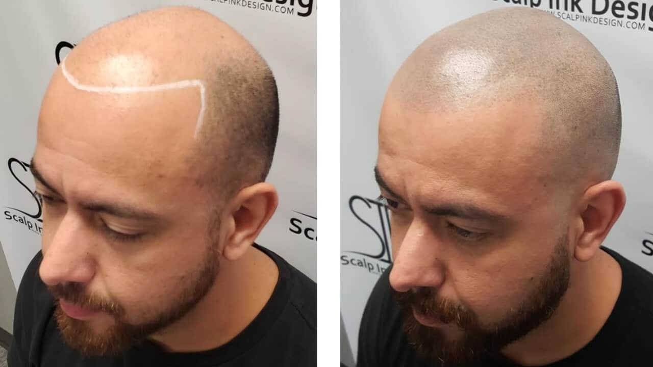 Scalp Micropigmentation Before and After - Scalp Ink Design - Miami Margate West Palm Beach Port St Lucie - Hair Tattoo