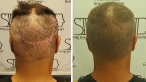 Scar Camouflage with Scalp Micropigmentation - Before and After - Scalp Ink Design - Miami Margate West Palm Beach Port St Lucie