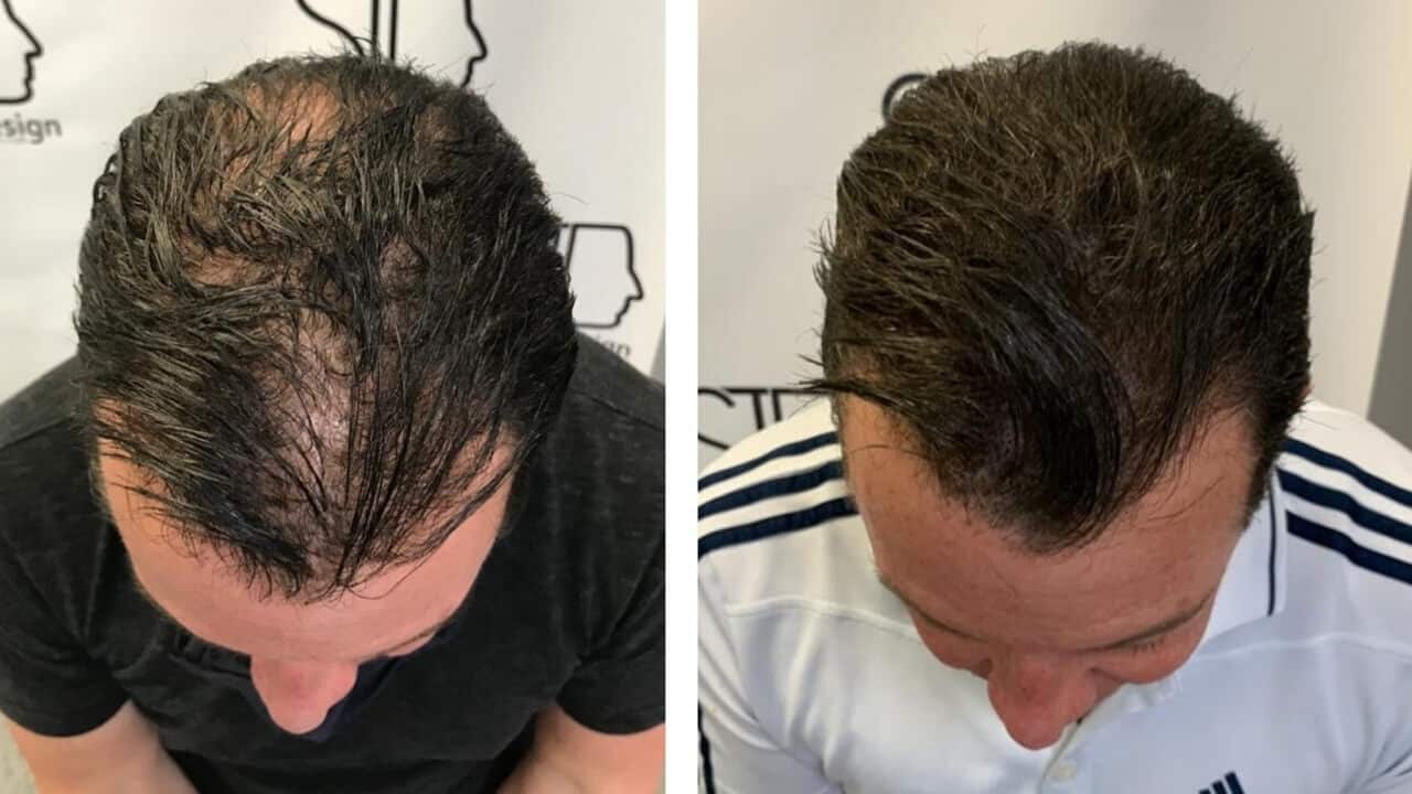 Hair Thinning Solution - Scalp Micropigmentation for Men and Women - Before and After Photos - Scalp Ink Design