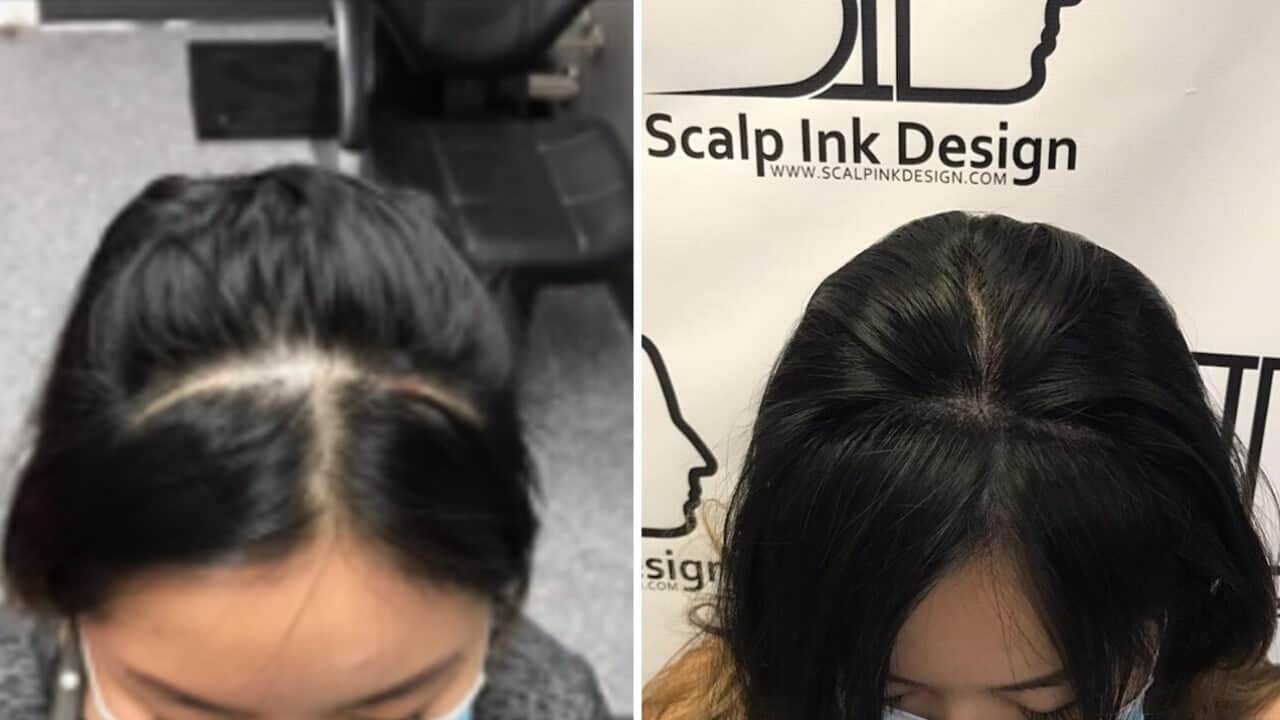 SMP Before and After Photos - Scalp Micropigmentation for Women - South Florida
