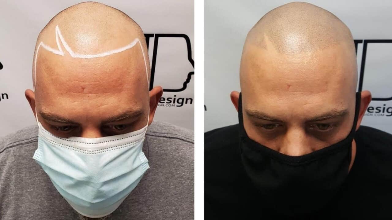 Scalp Micropigmentation Before and After Photos - Shaved Look - Hair Loss Treatment Results