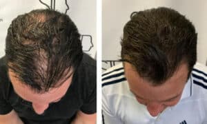 Scalp Micropigmentation Before and After - Add Hair Density - SID