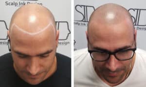 Scalp Micropigmentation Before and After - Shaved Look