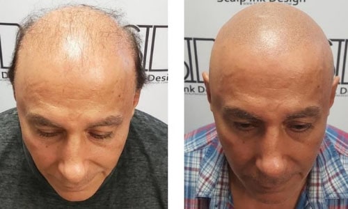 Scalp Micropigmentation Before and After - Shaved Look Results