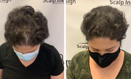 Scalp Micropigmentation - Add density to the scalp