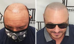 SMP Before and After - Shaved Look - Scalp Ink Design