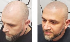 Shaved Look - Scalp micropigmentation for men - Florida Scalp Ink Design