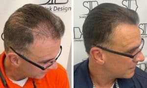 scalp micropigmentation results - before and after - scalp ink design